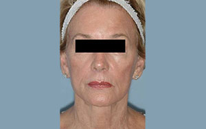 Lifting Facial - Inainte