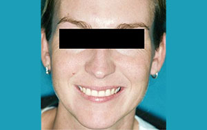 Lifting Facial - Inainte