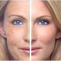 Lifting Facial